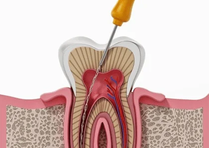 Teeth Cleaning