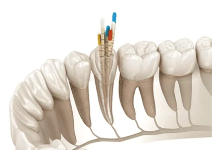 Teeth Cleaning