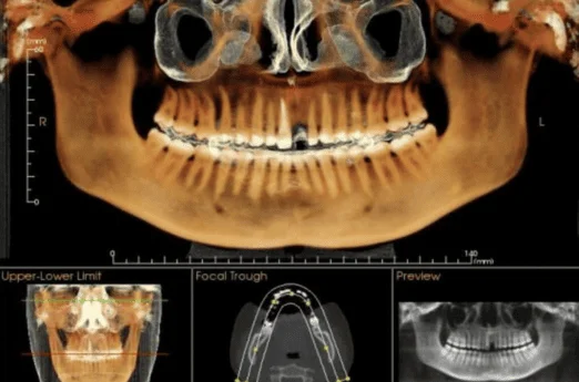 Teeth Cleaning