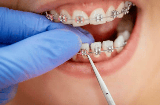 Teeth Cleaning